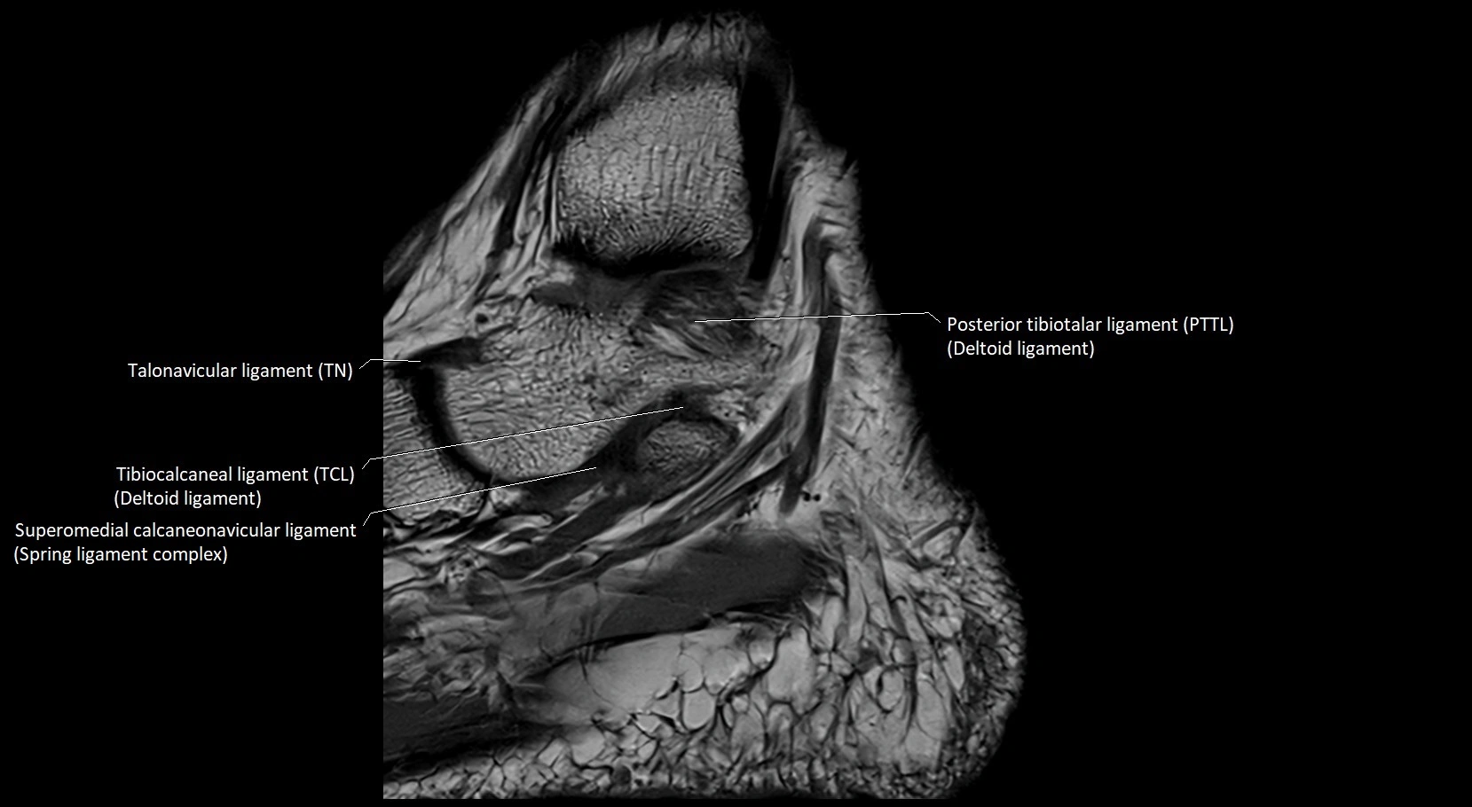 MRI ankle ligaments anatomy sagittal 3T image 6.webp